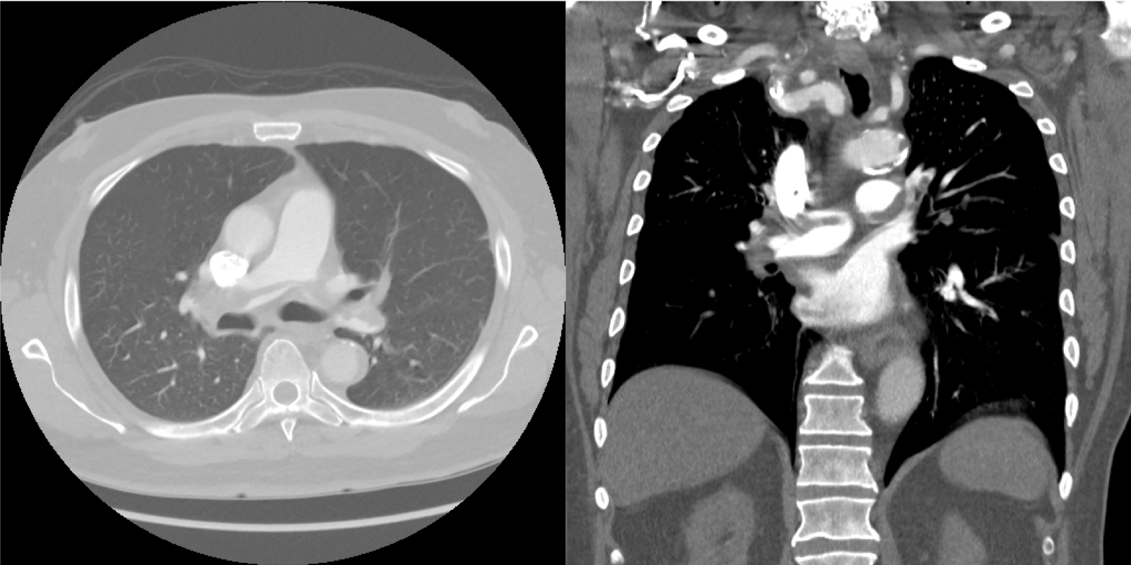 Axial and coronal views of a CT PE study demonstrating a saddle pulmonary embolus seen as a filling defect in the main pulmonary artery with extension into the right and left pulmonary arteries