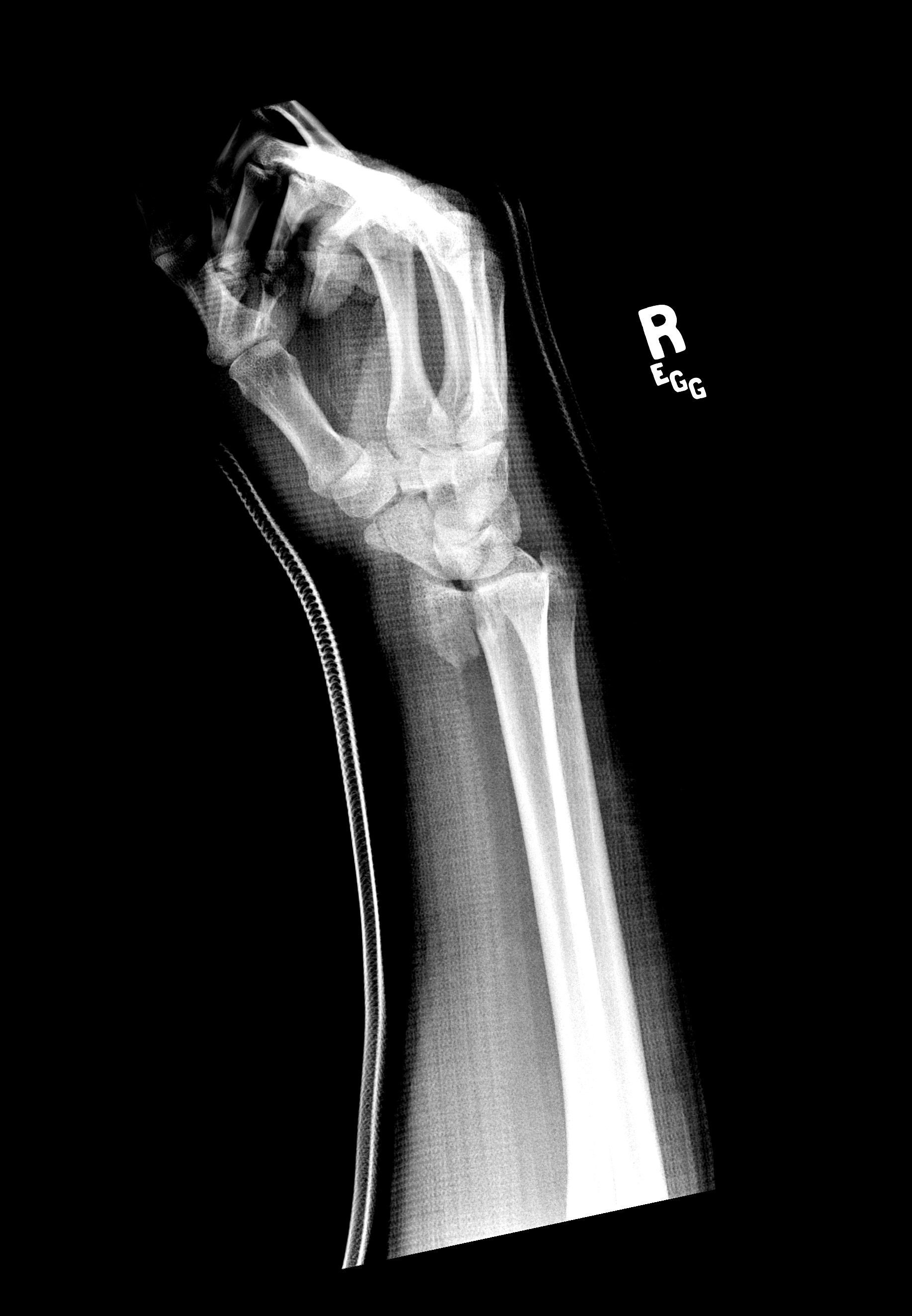 Distal radius forearm fracture.