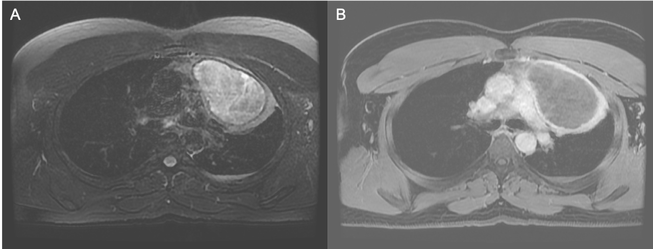 Axial T2 fat-sat image (A) showing an anterior mediastinal cystic mass