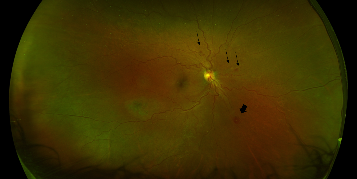 Retinal photograph of a patient with candidemia showing multiple retinal hemorrhages (arrows) and a Roth spot (arrow-head).