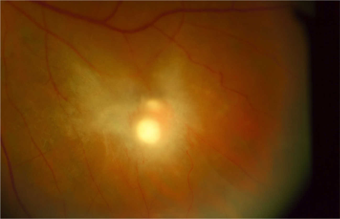 Healing chorioretinal Candida lesion with scarring and retinal traction