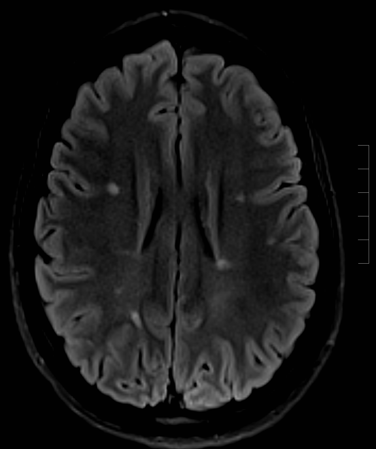 <p>Perivascular Plaques in Multiple Sclerosis as Seen in MRI