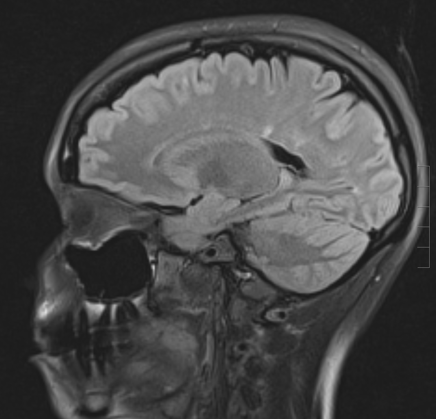 <p>Sagittal FLAIR Sequence&nbsp;Demonstrating&nbsp;a Hyperintense Lesion on MRI