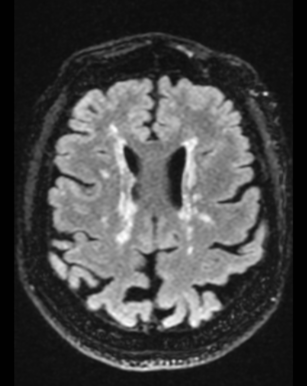 <p>Axial FLAIR Sequence Demonstrating an Advanced Lesion Burden on MRI