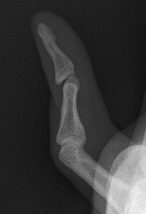 Boutonniere deformity of the 5th digit.