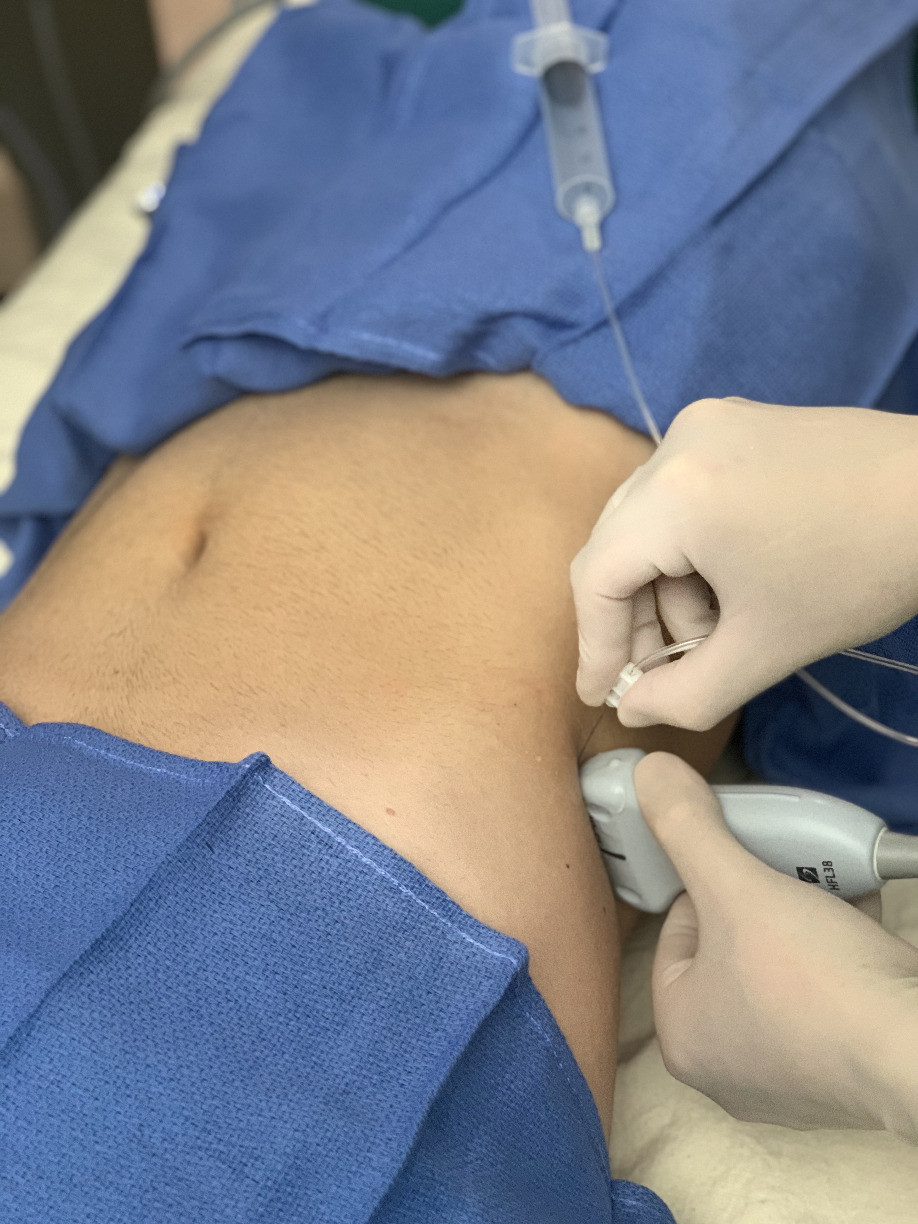 <p>Posterior TAP Block Approach. Probe and needle position for posterior transabdominal plane (TAP) block approach.</p>