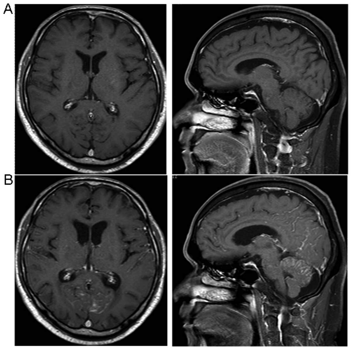 Figure 2 Referencing PMID 27017242, Sanctuary Site Leptomeningeal Metastases in HER-2 Positive Breast Cancer: A Review in the