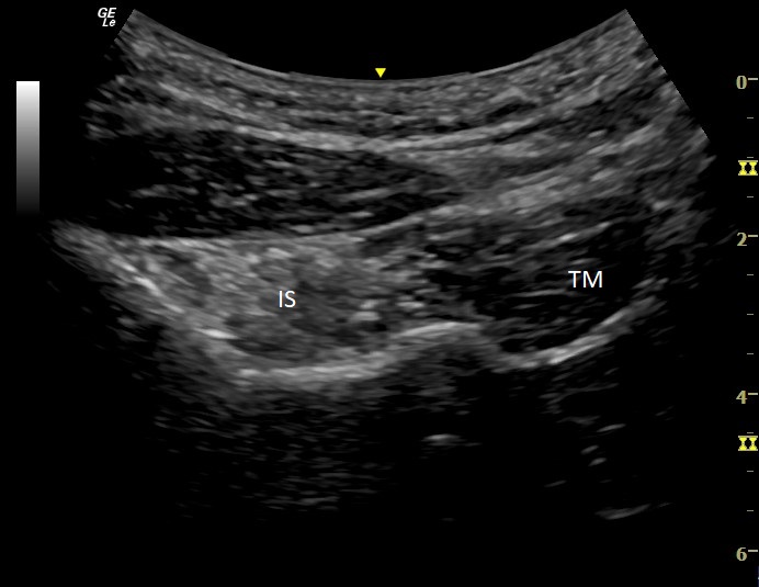 <p>Infraspinatus Muscle Atrophy, Ultrasound