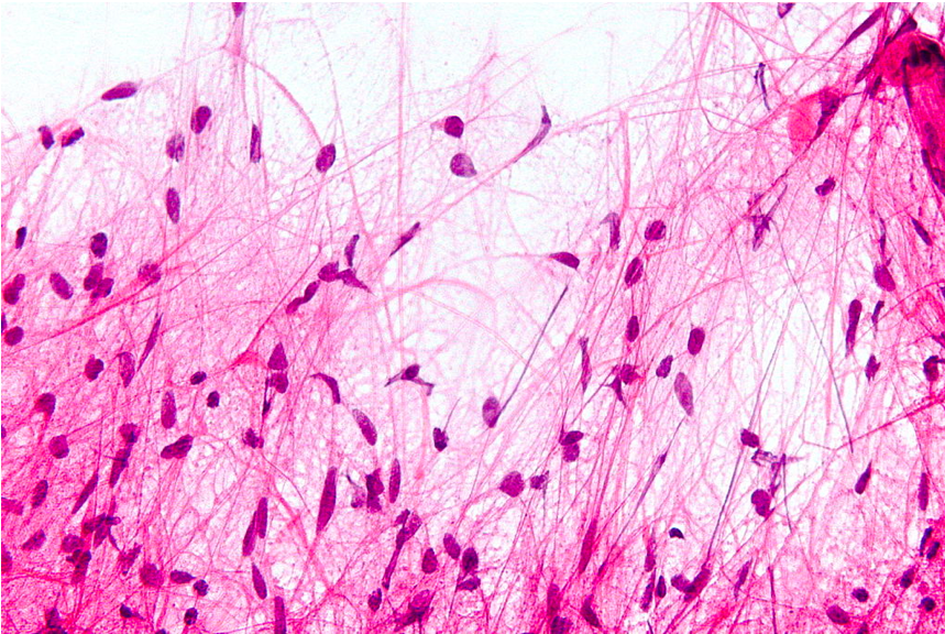 <p>Microscopic Features of Pilocytic Astrocytoma. Hair-like cell processes with H&amp;N staining.</p>