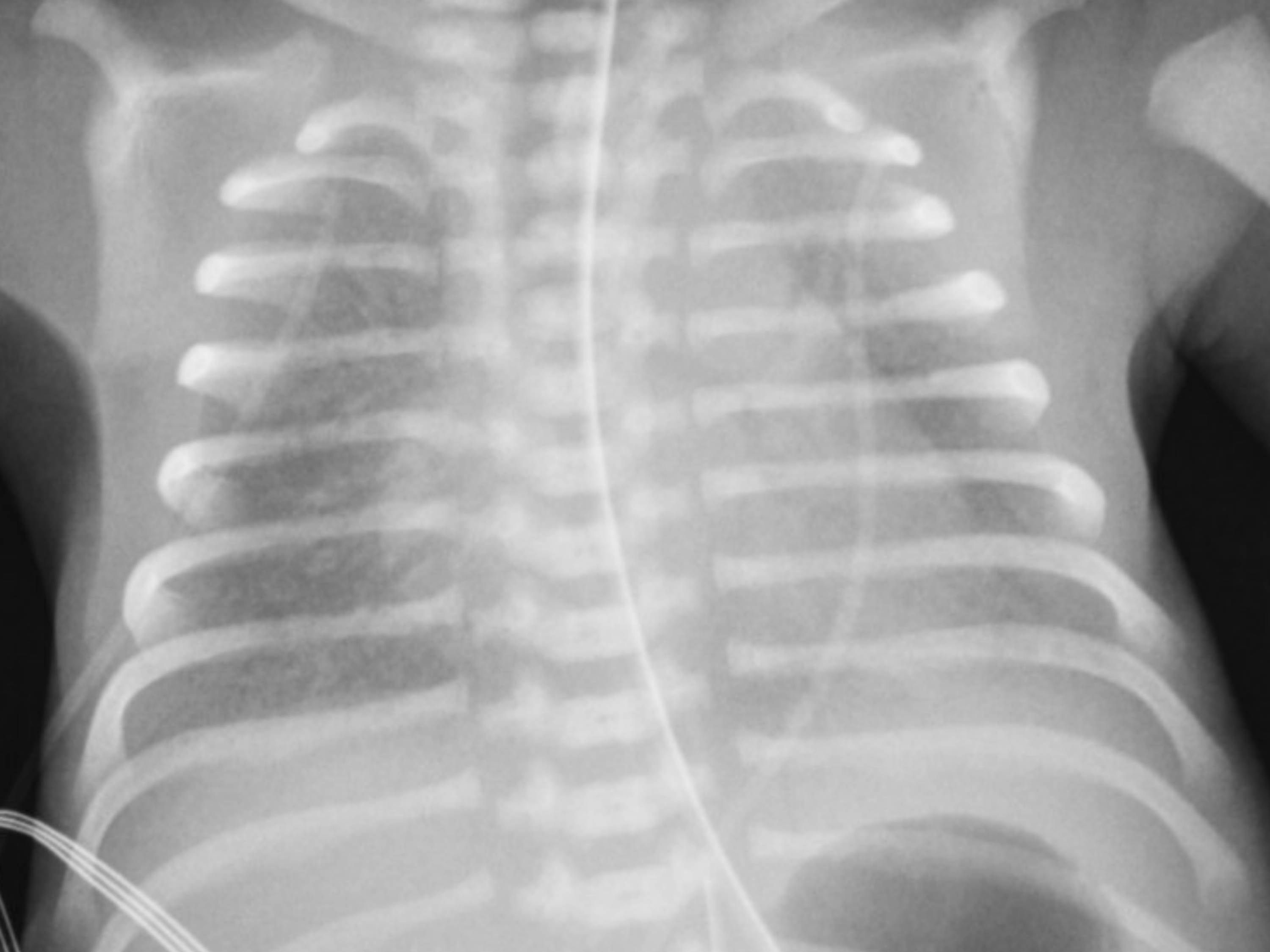 This is a chest radiograph of a preterm neonate with respiratory distress syndrome showing diffuse ground glass haziness bilaterally with air bronchograms