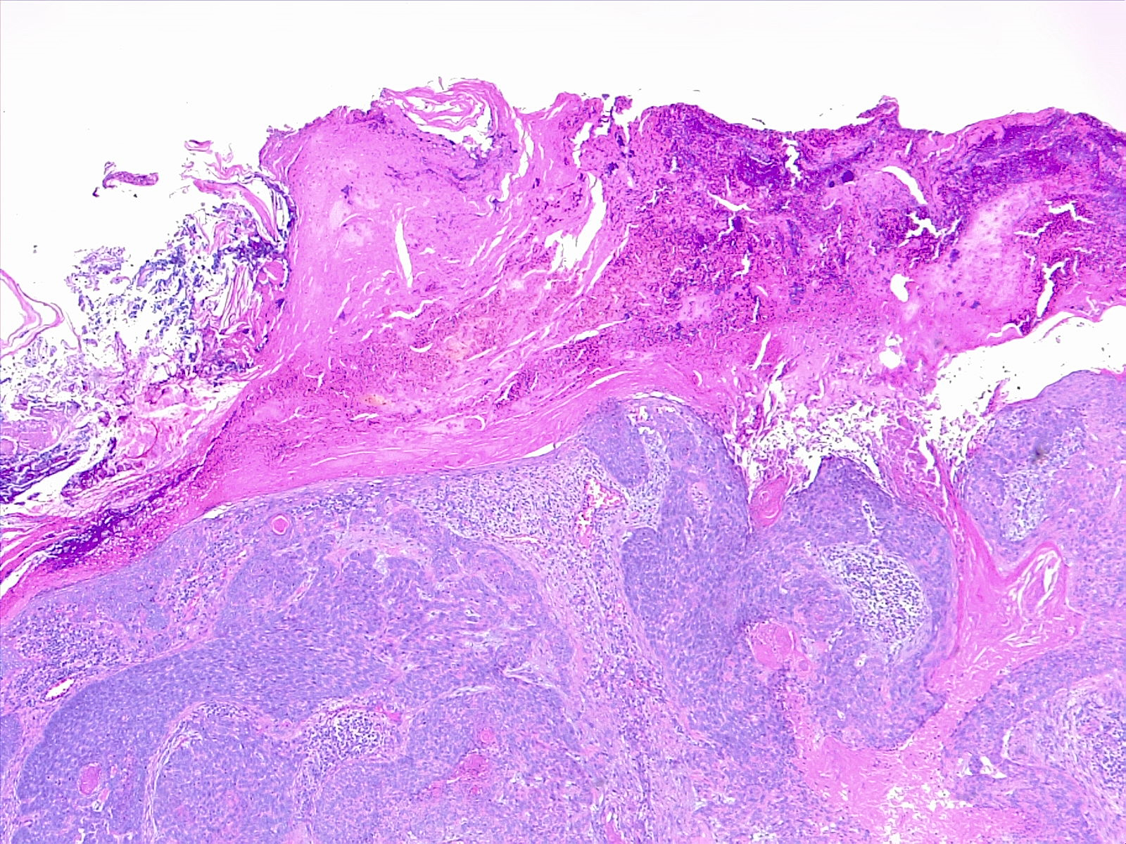 <p>Histological Slide of Cutaneous Squamous Cell Carcinoma