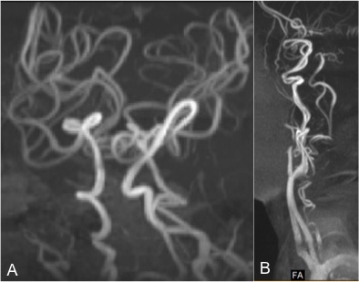 Fig 2 (MR angiogram) showing tortuous cerebral blood vessels
(A) and neck vessels 
(B) in patients with Menkes disease.