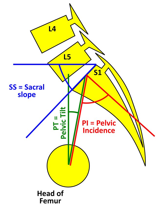 Spino pelvic parameters showing Pelvic tilt (PT), Sacral slope (SS) and Pelvic incidence (PI)