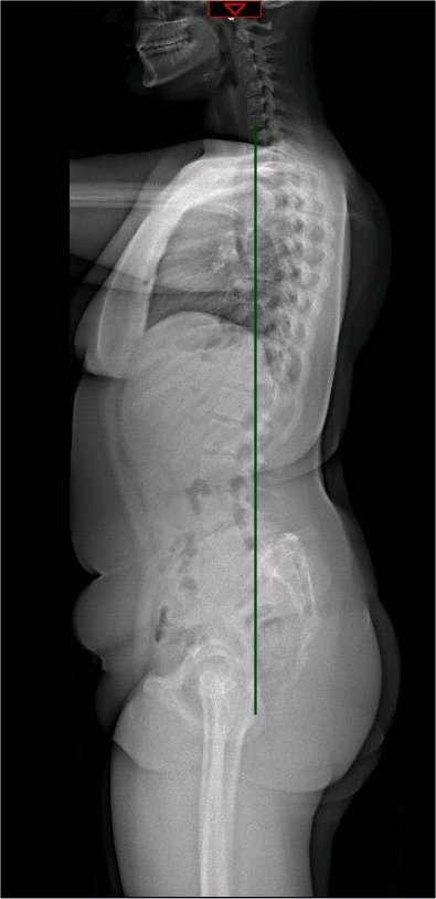 Whole spine X-ray showing C7 plumbline