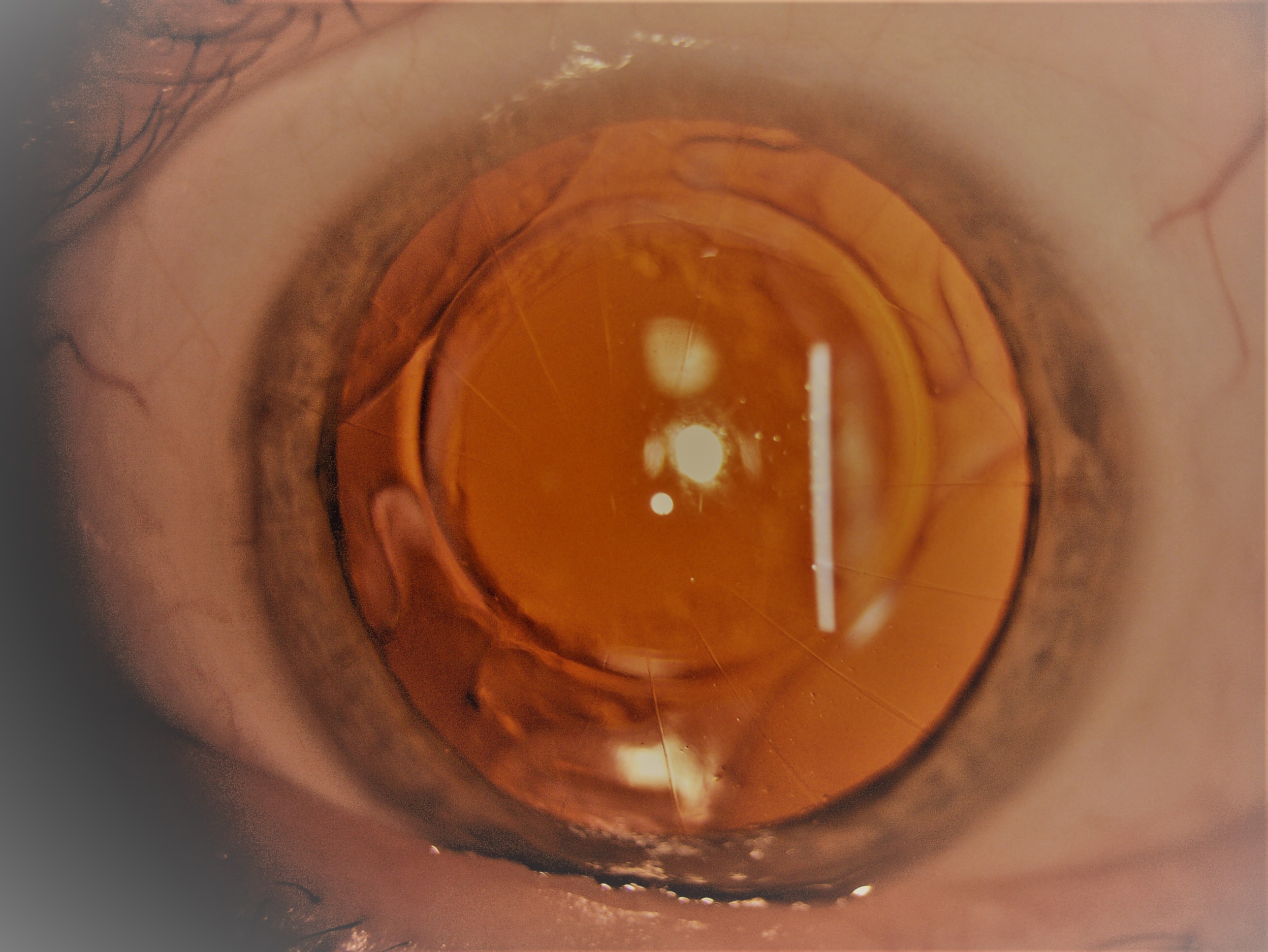 16-incision radial keratotomy in the left eye