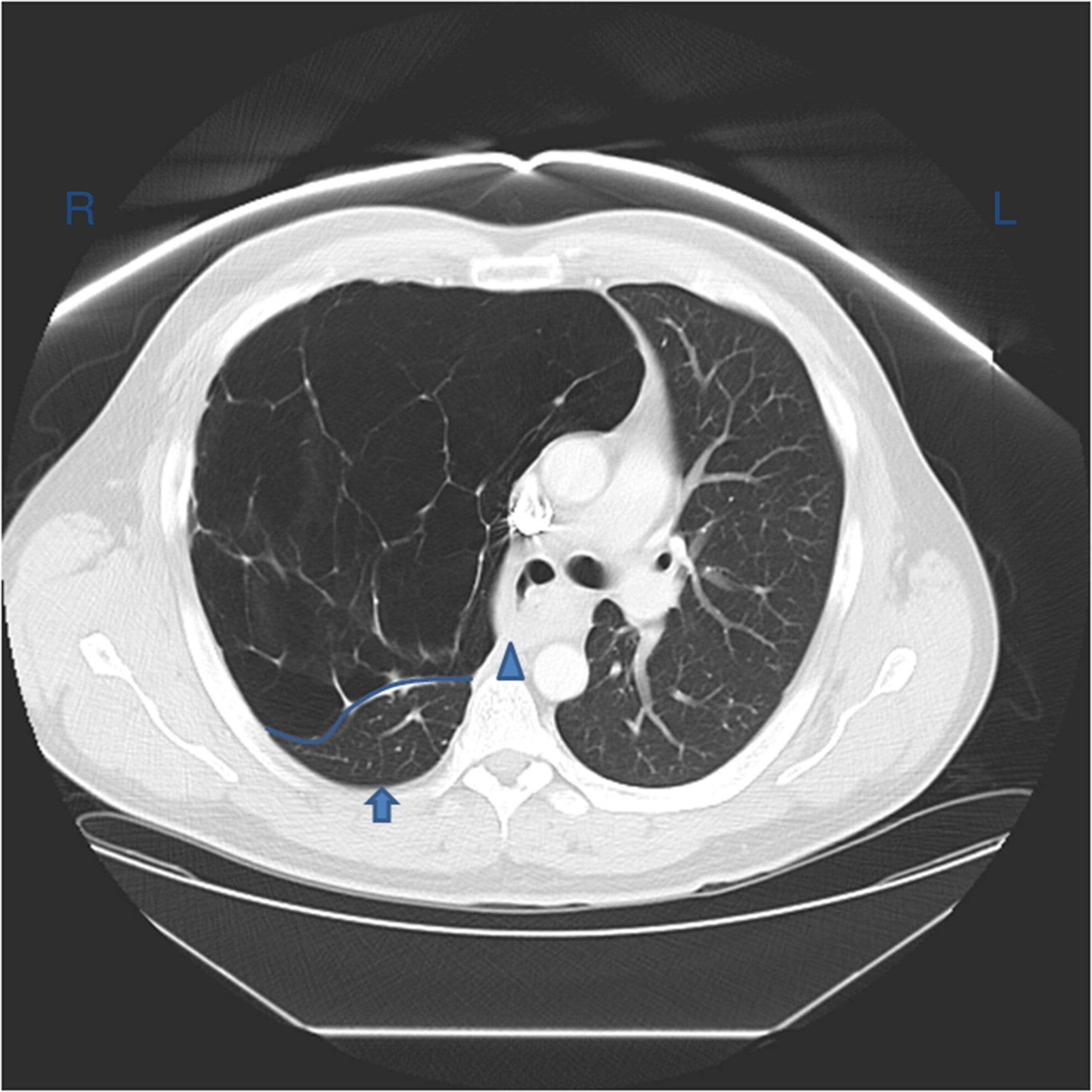 Chest computed tomography showing extensive emphysema in the right middle lobe and compressive atelectasis of the right upper lobe