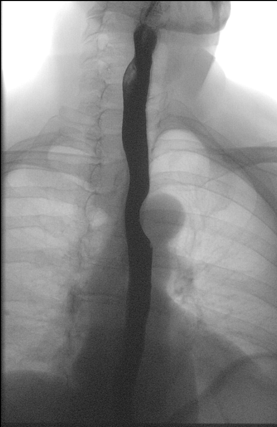 Single frontal image taken during a barium swallow exam demonstrating contrast in the esophagus.