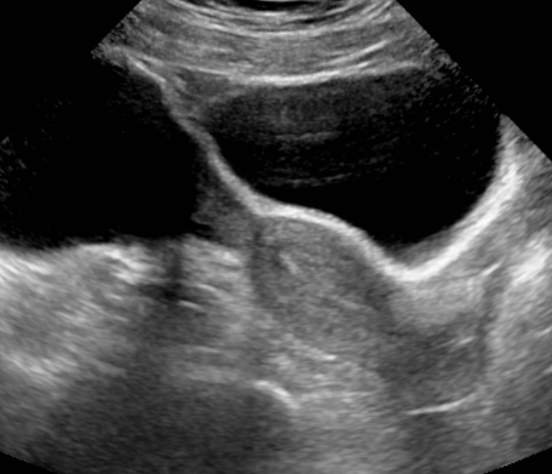 <p>Transabdominal Longitudinal View of the Uterus.</p>