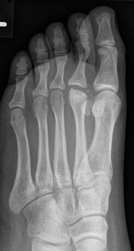 Radiograph of foot with Kohler disease, Morbus Köhler-Freiberg Freiberg disease 15 Year old female.
