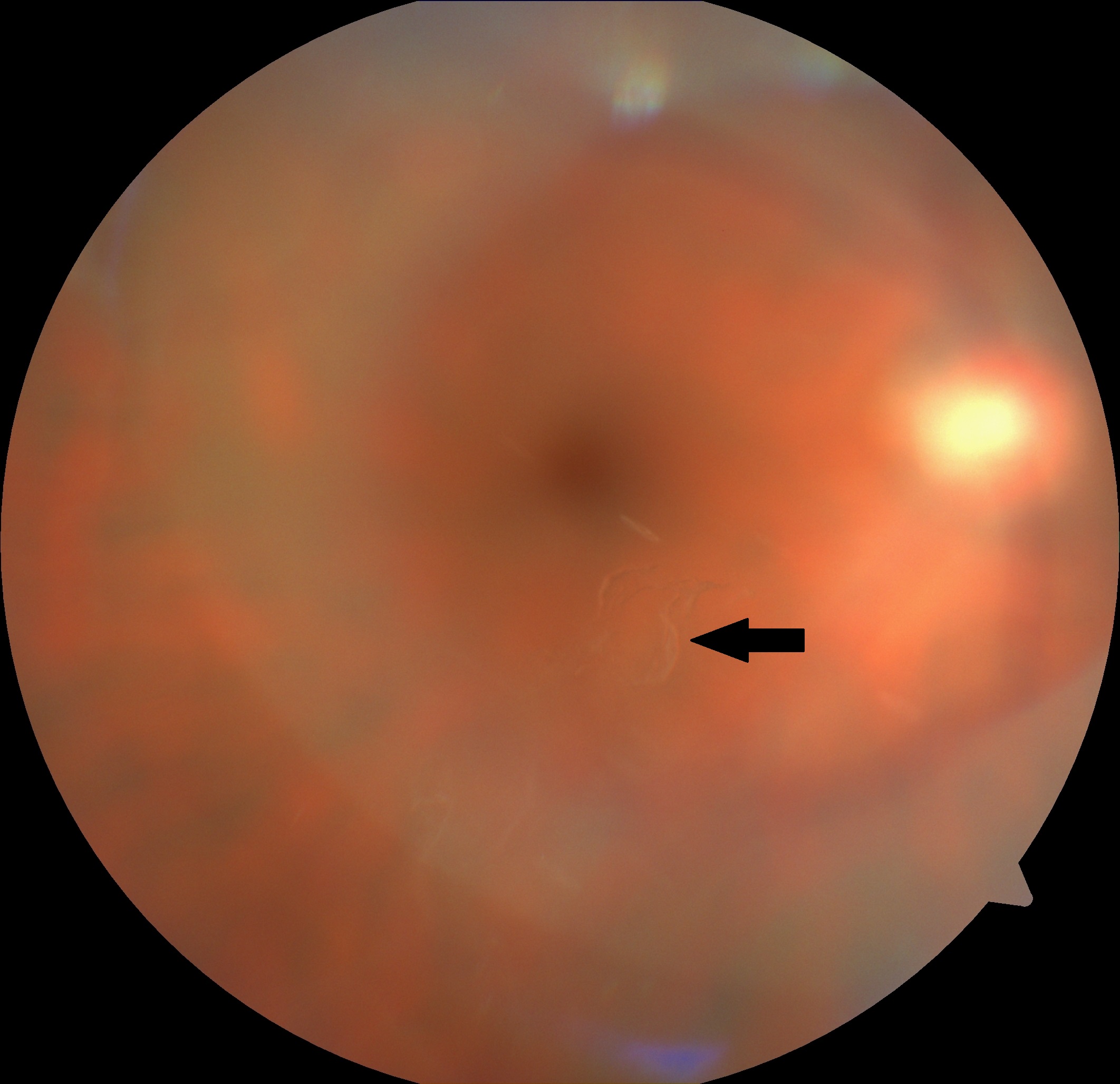 Color fundus photo showing a Weiss ring