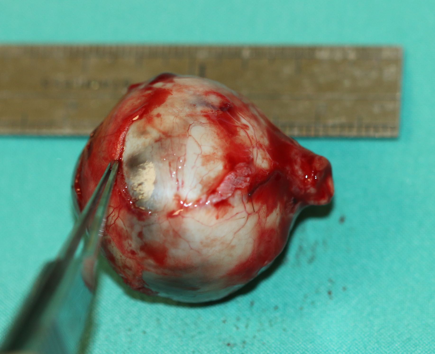 Enucleation