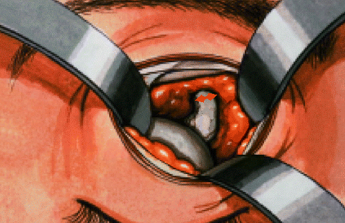 Enucleation: technique of the supero-medial approach to the optic nerve so that the optic nerve may be cut under direct vision, thereby avoiding the risk of transecting the globe in the presence of an introcular tumor
