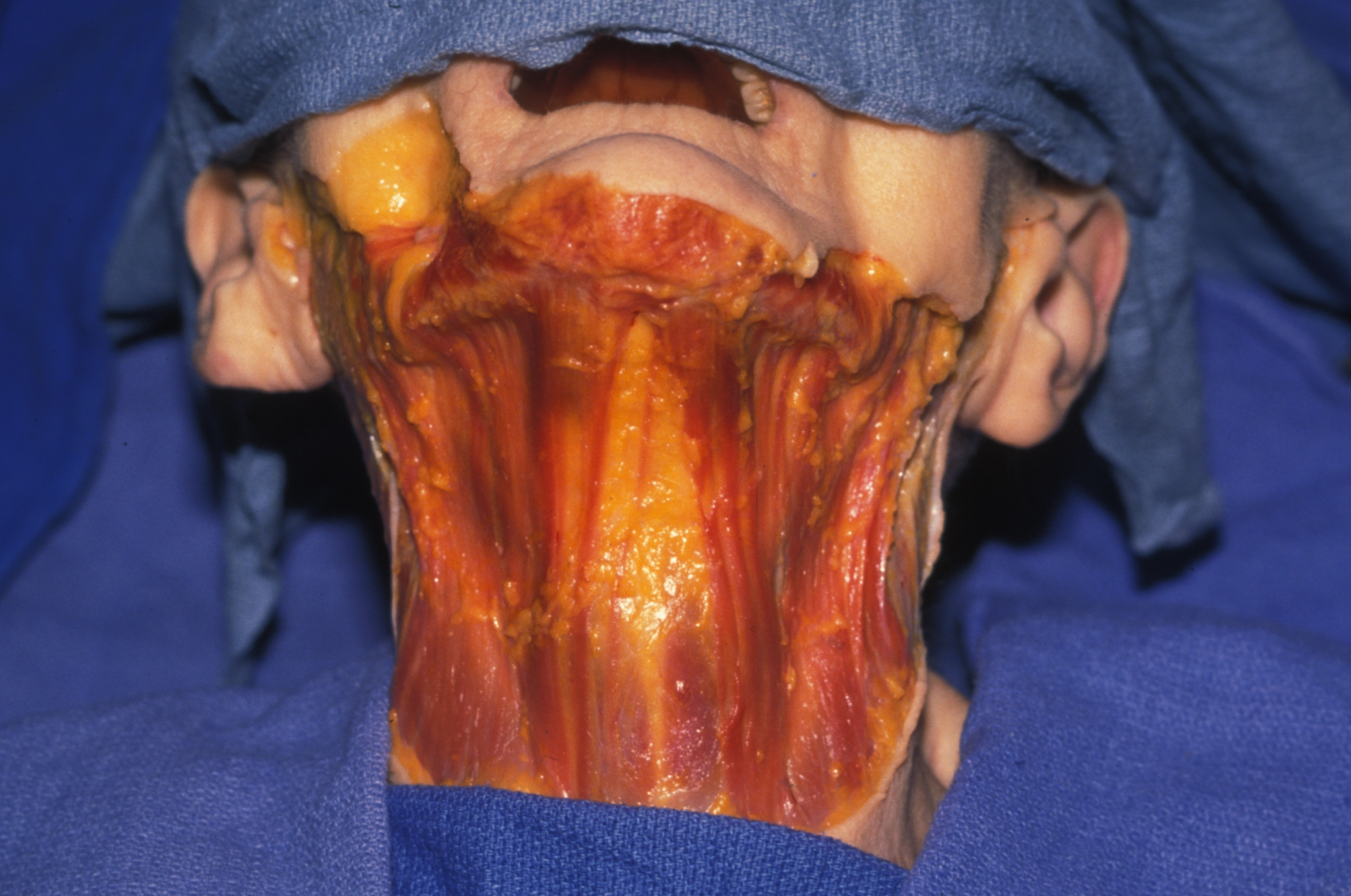 The platysma muscle: note the central separation of muscle fibers which occurs with age