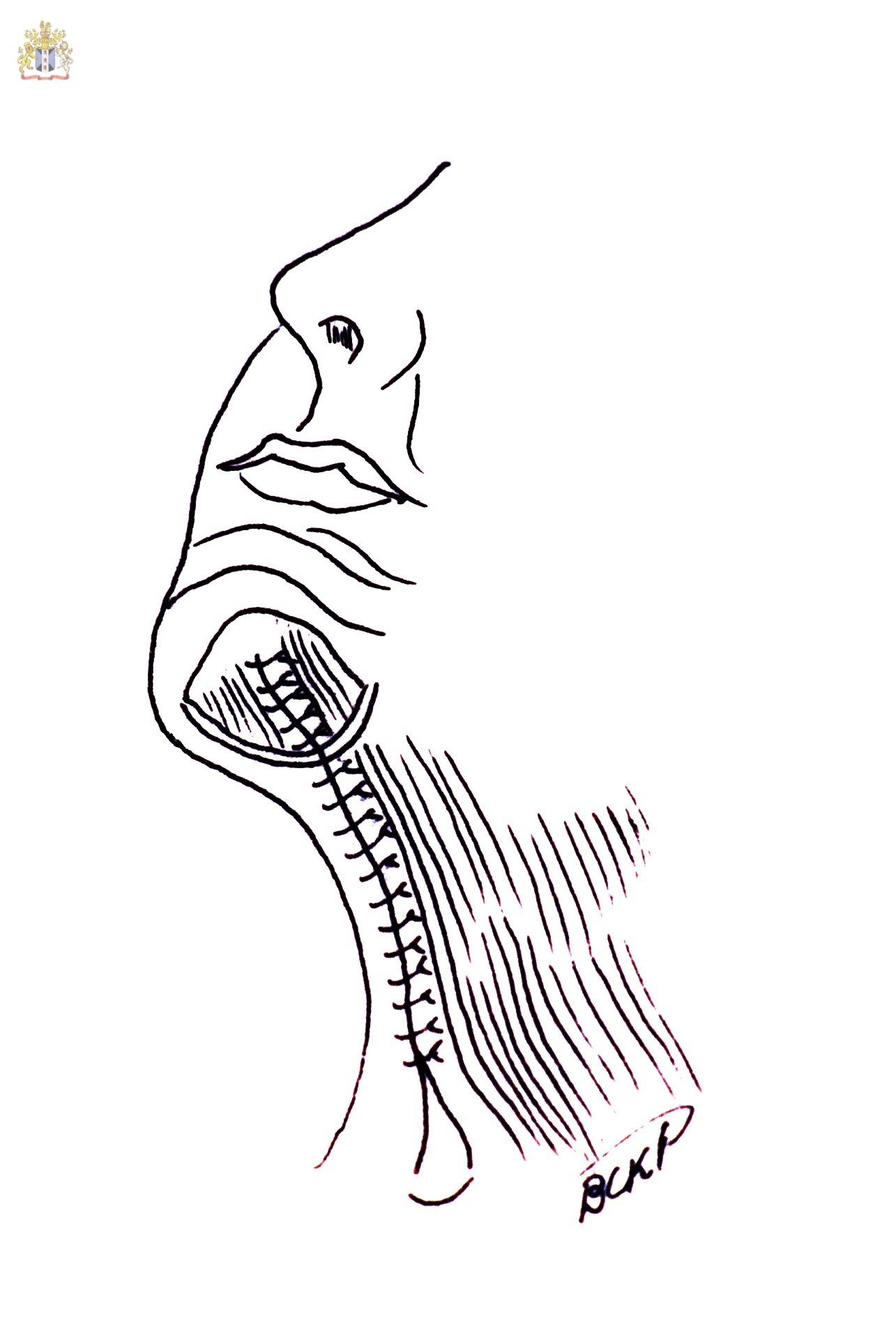 The Corset Platysmaplasty where the medial separated platysmal bands are sutured with two or three layers of sutures from the mentum to the supraclavicular zone