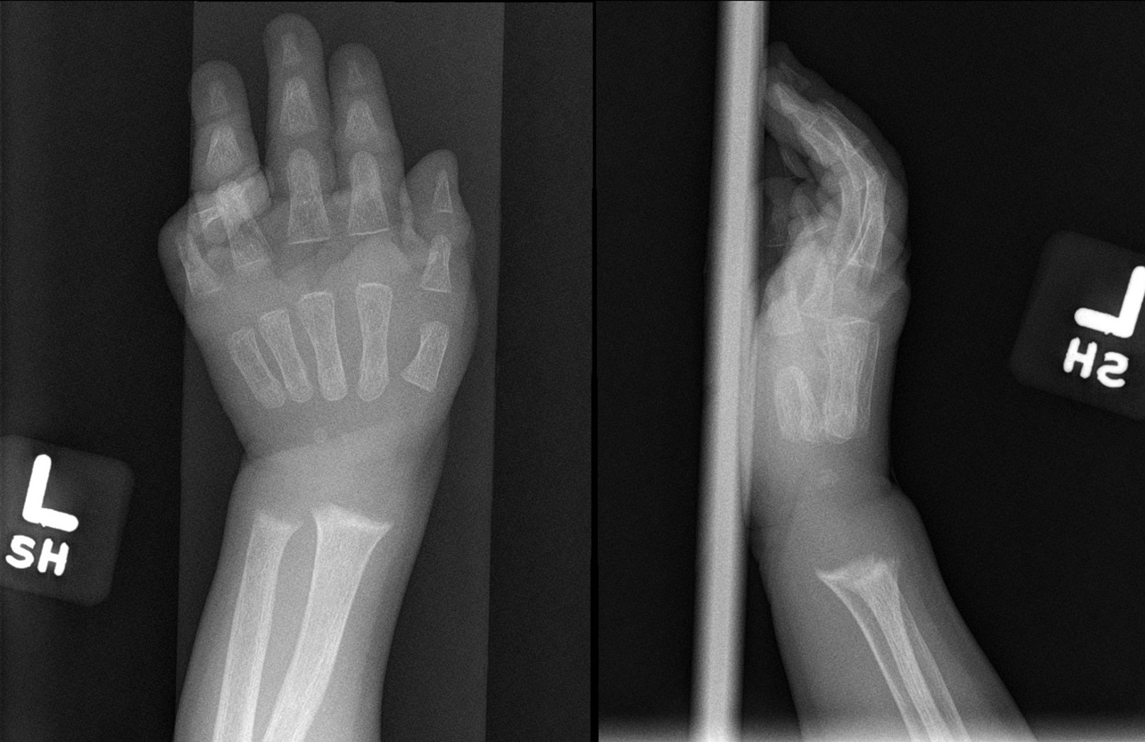 Radiograph of the left wrist (anteroposterior and lateral views) showing metaphyseal widening and irregularity of the distal 