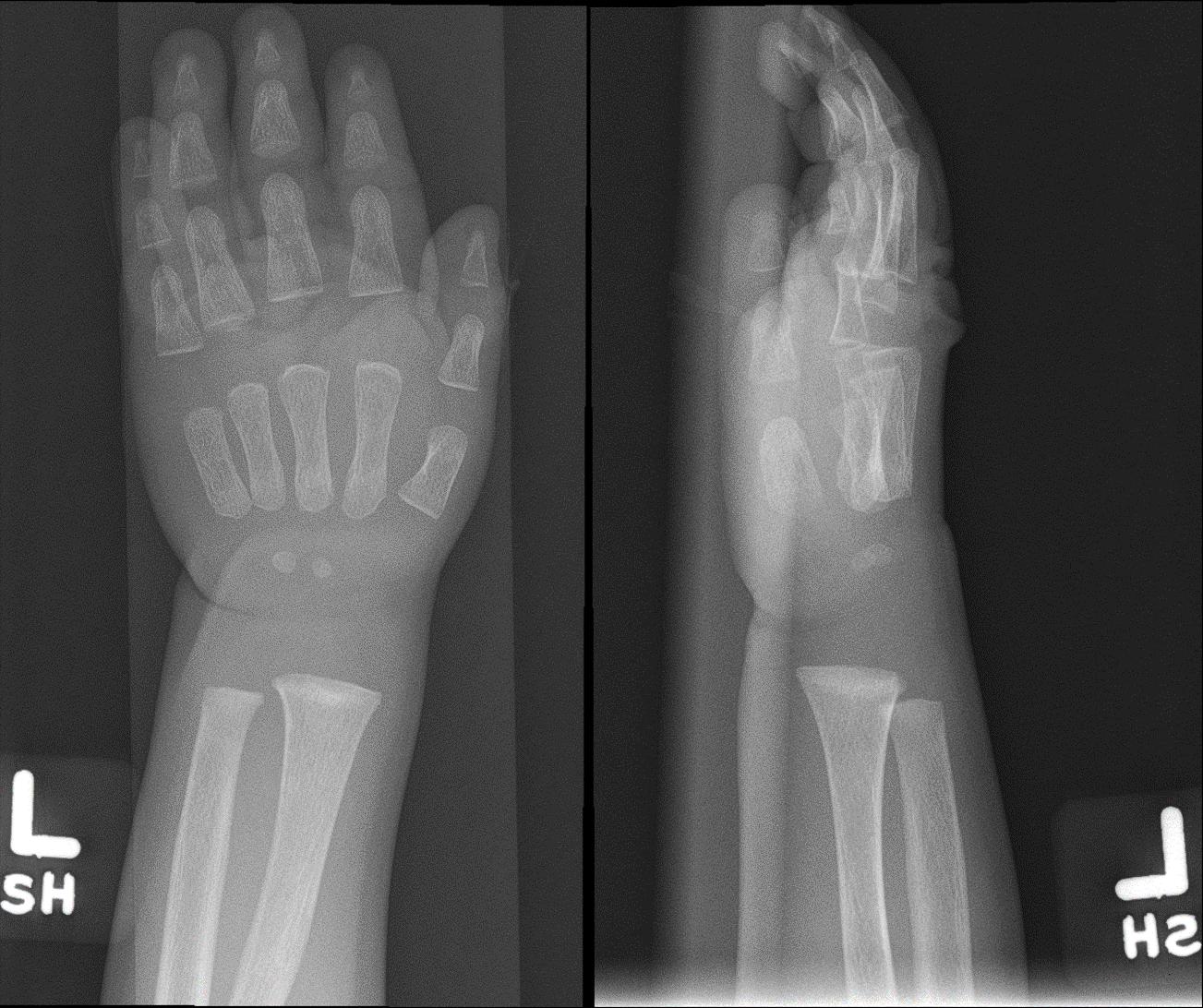 Radiograph of the left wrist (anteroposterior and lateral views) taken three months later showing improved density and appearance of the distal metaphysis after initiation of treatment for rickets