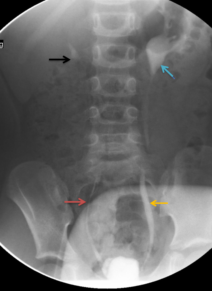 <p>Fluoroscopic Spot Image of Voiding Cystourethrogram