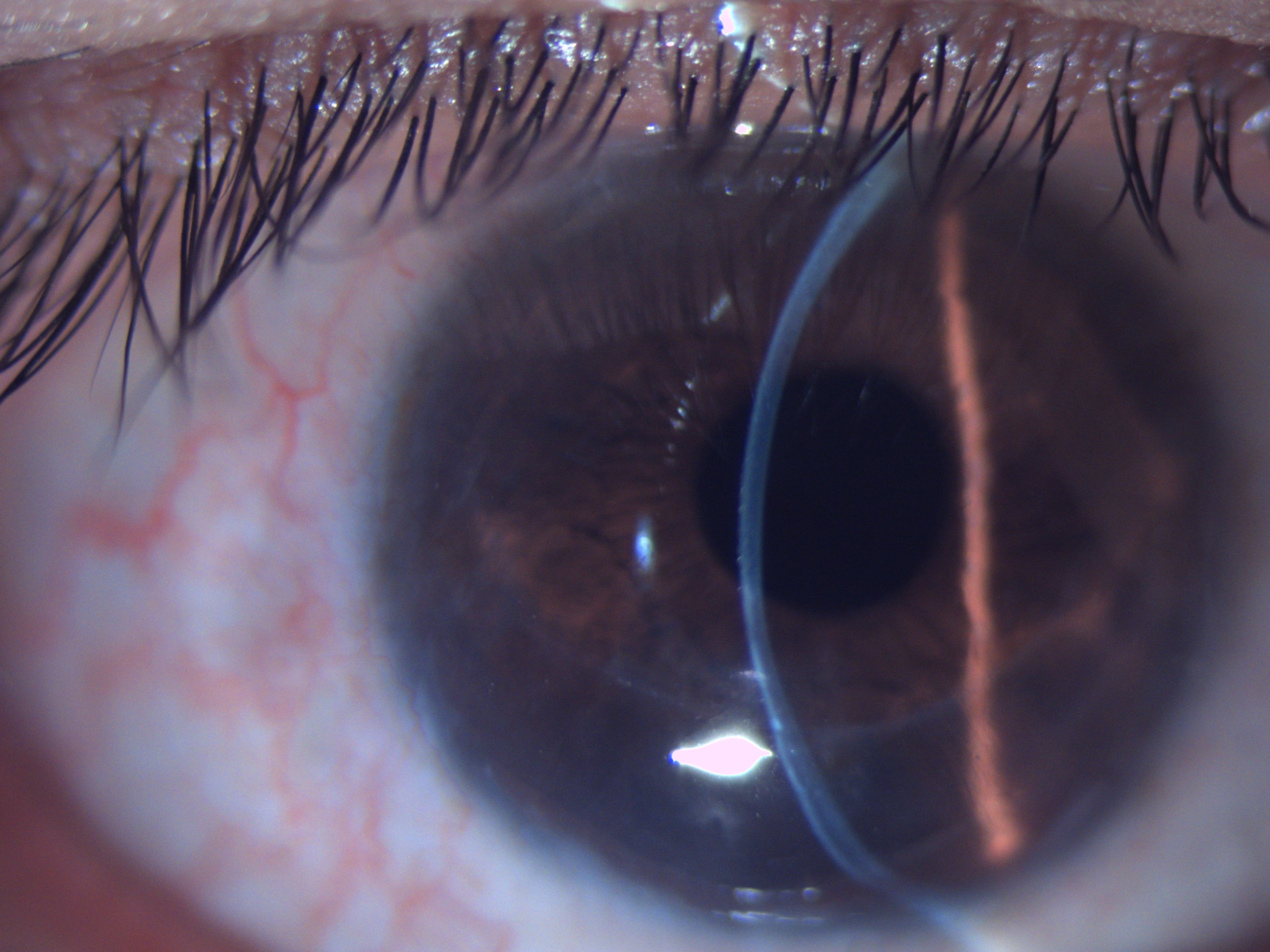 Slit section of cornea showing inferior thinning and ectasia in Pellucid marginal corneal degeneration.
