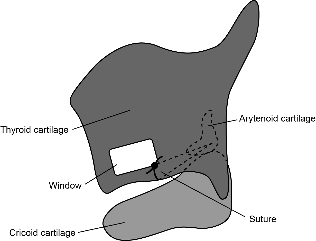 Diagram of arytenoid adduction procedure, lateral view.
