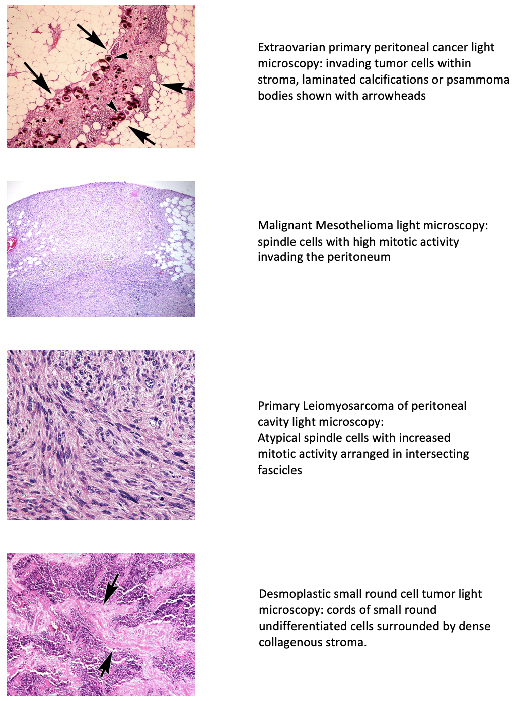 <p>Light Microscopic Features of Types of Peritoneal Cancer</p>