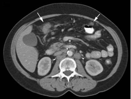 <p>Infiltration and Nodularity of Peritoneum