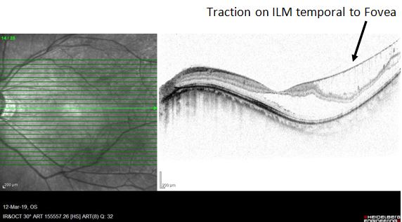 <p>Traction on the ILM: Temporal to Fovea