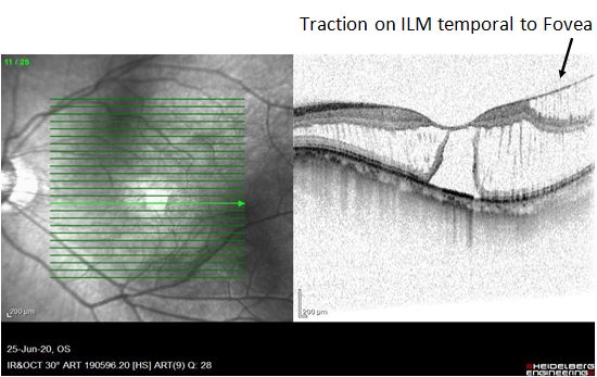 <p>Traction on ILM, Temporal to the Fovea
