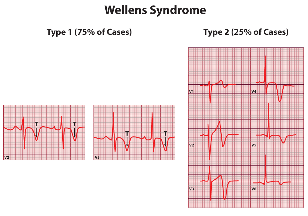<p>Wellens Syndrome. Wellens syndrome including type 1 and type 2.</p>