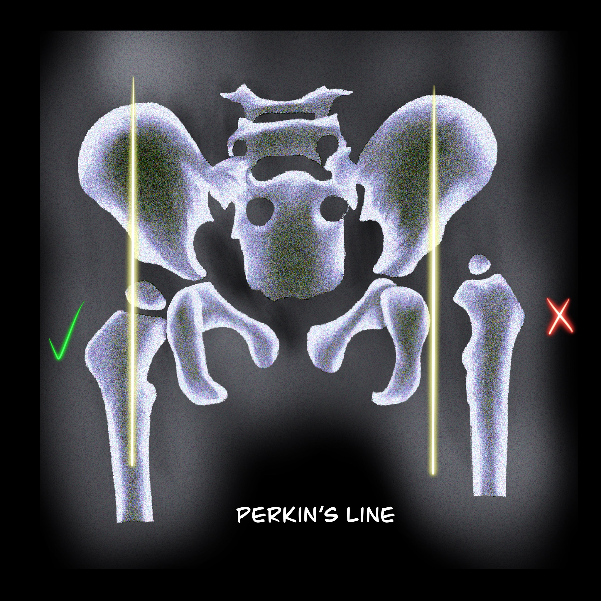 <p>Perkin Line. The femoral head is normally medial to this line.</p>