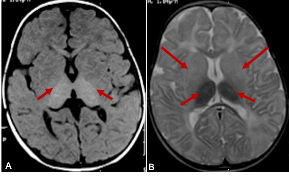 Brain MRI in a 9-months-old boy with Tay Sach's disease