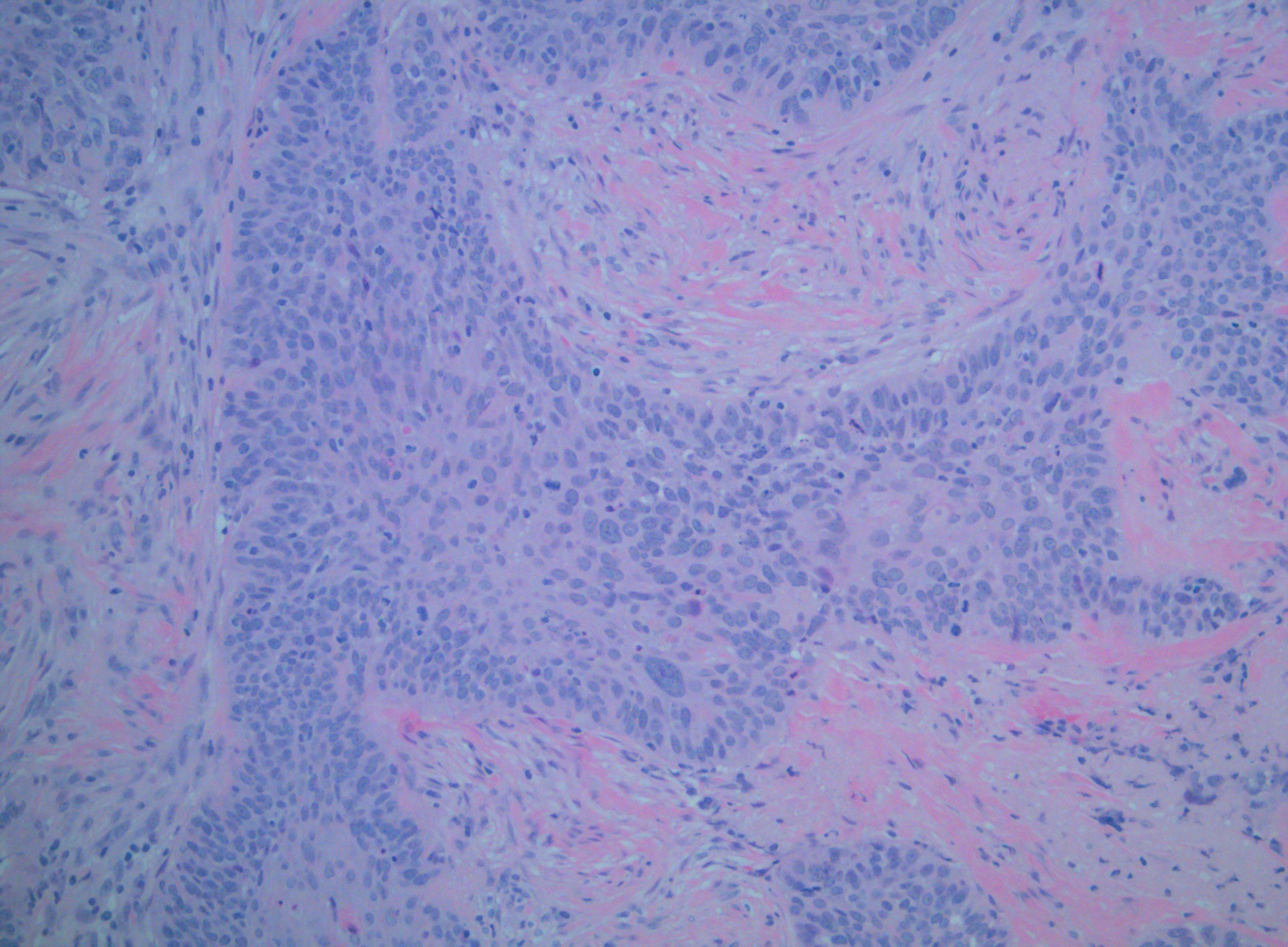 <p>Squamous Cell Carcinoma (SCC) of the Palate Without P16 Staining</p>