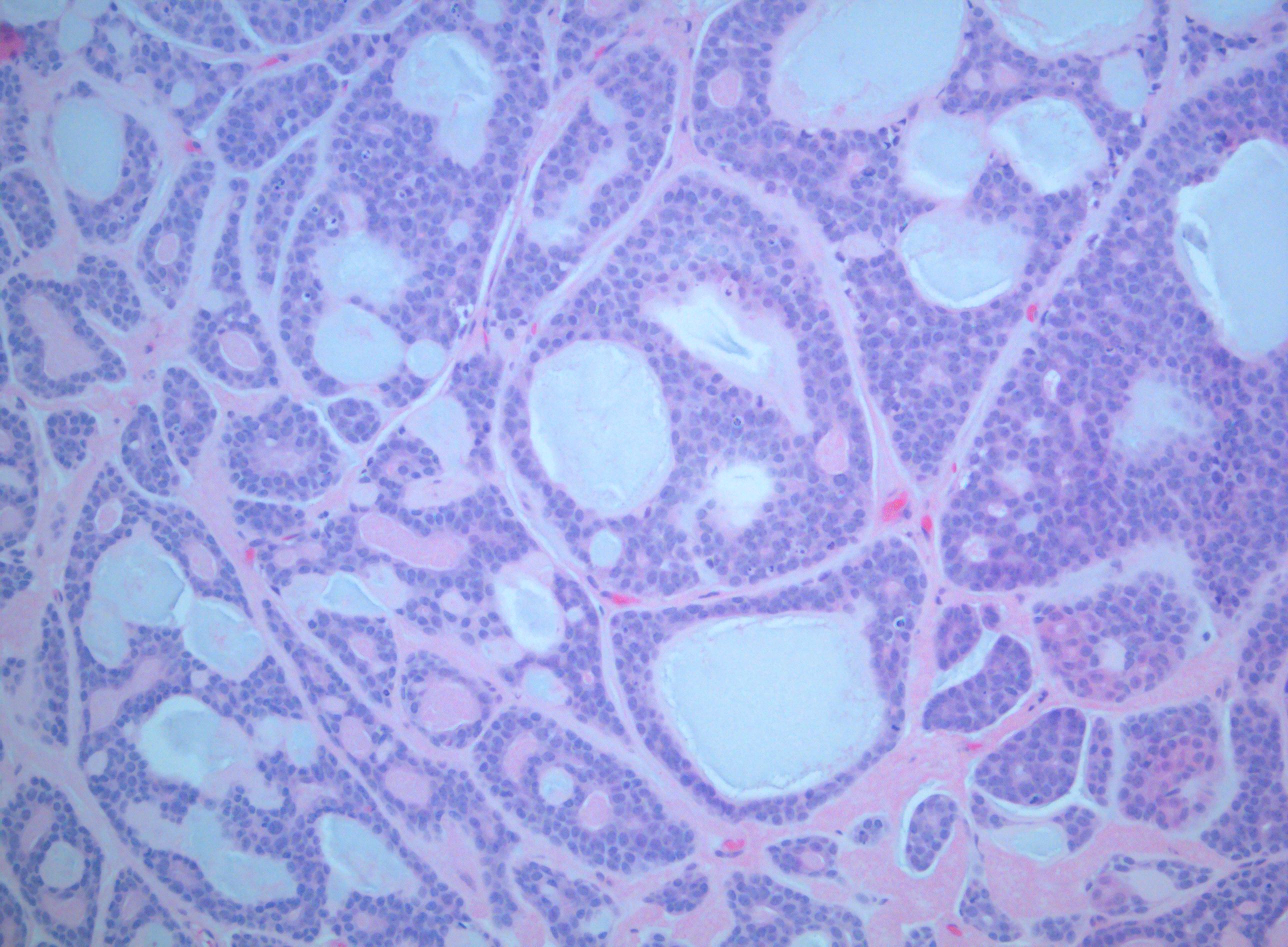 <p>Acinic Cell Carcinoma (ACC) of the Palate</p>