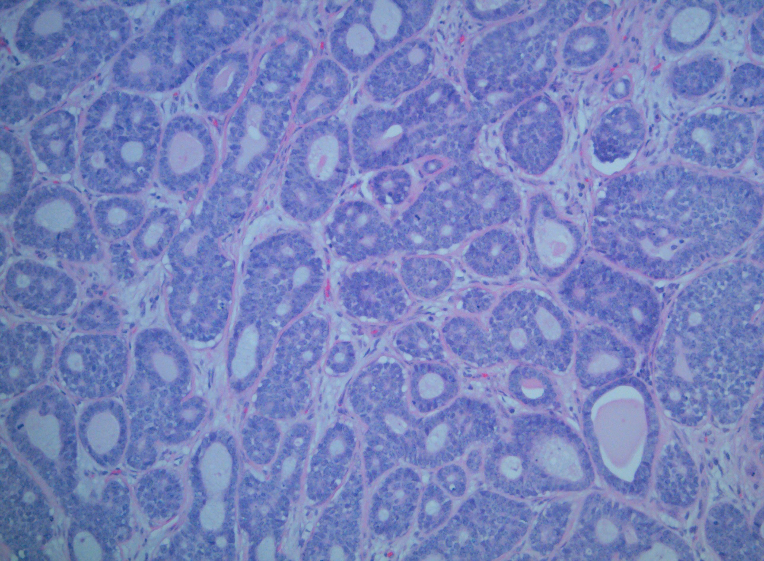 <p>Adenoid Cystic Carcinoma (AdCC) of the Palate</p>