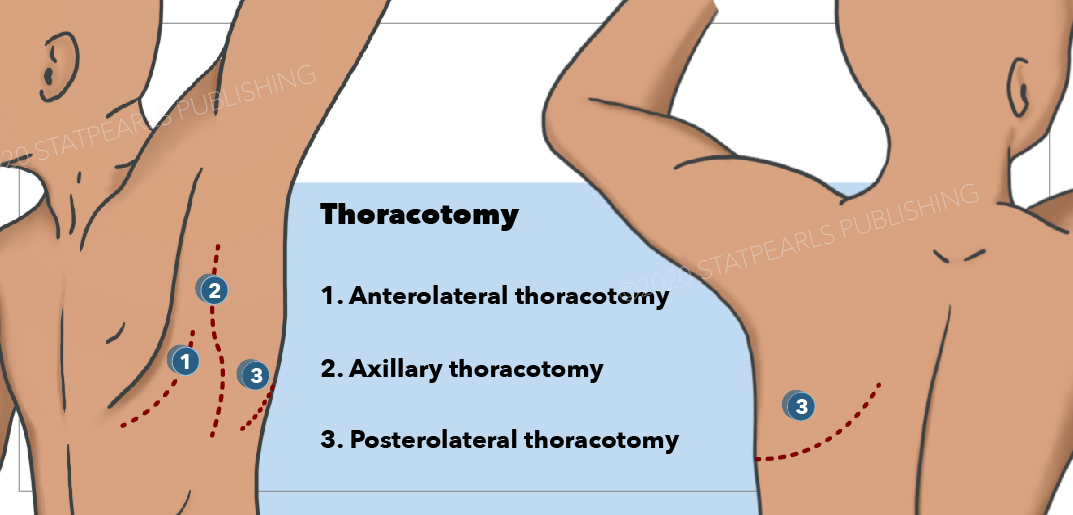 <p>Thoracotomy. Anterolateral thoracotomy, axillary thoracotomy, and posterolateral thoracotomy.</p>