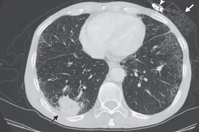 <p>Squamous Cell Carcinoma of the Lung. Chest CT image of squamous cell carcinoma.</p>