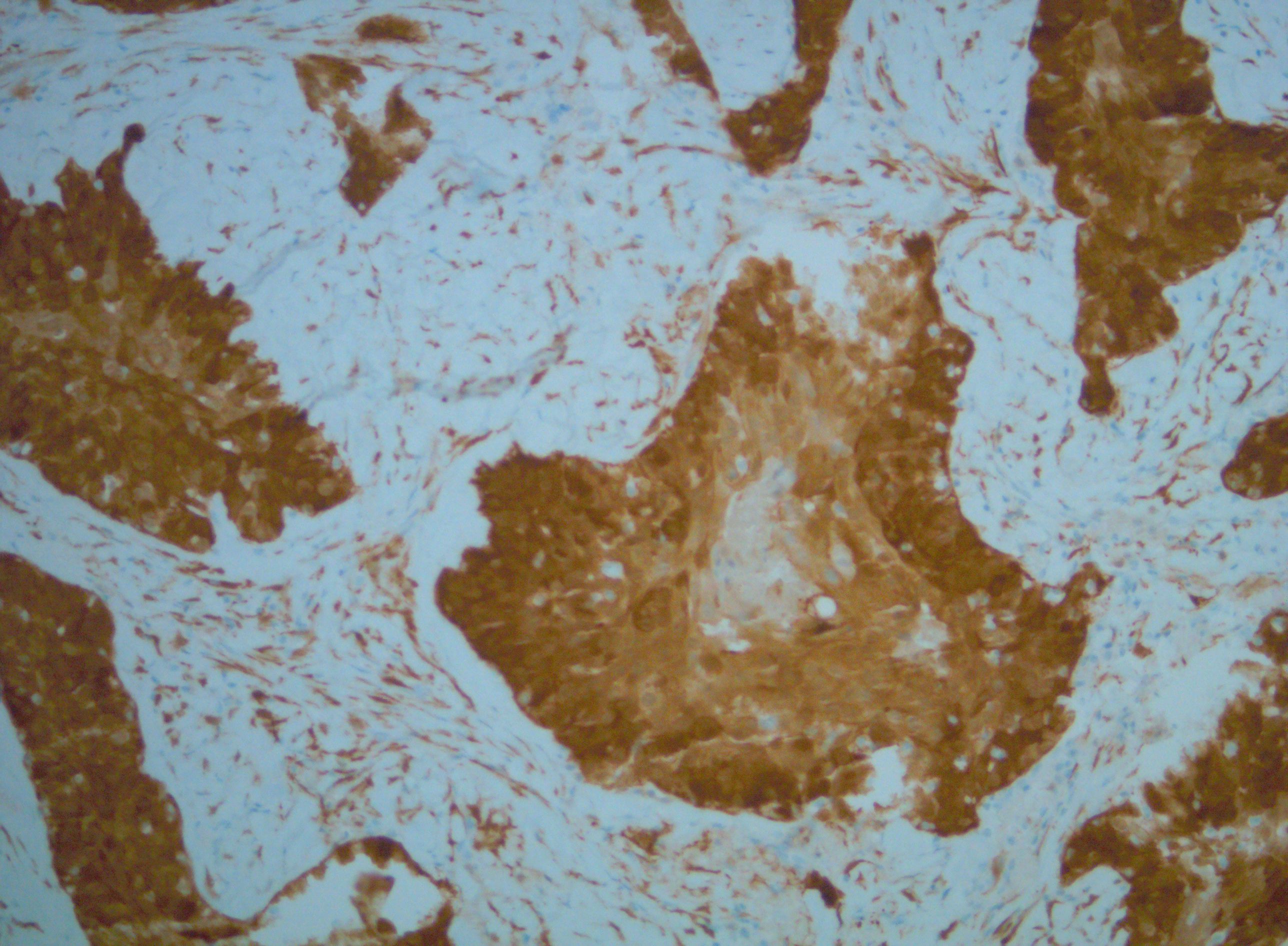 <p>HPV-Positive Squamous Cell Carcinoma (SCC) of the Palate With P16 (+) Staining</p>