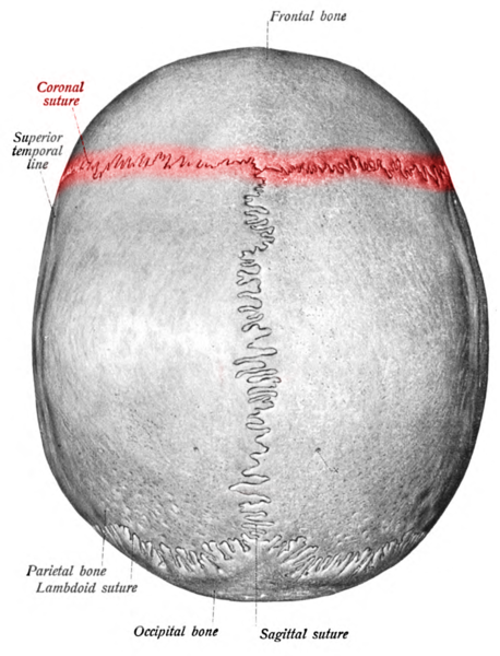 <p>Coronal Suture Lined as Red</p>