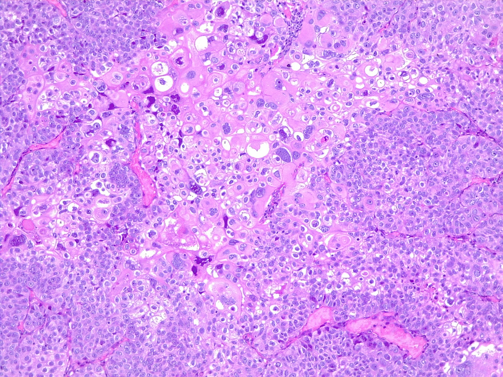 <p>Poorly Differentiated Urothelial Carcinoma With Metaplastic Squamous Appearance. 10x, H/E.</p>