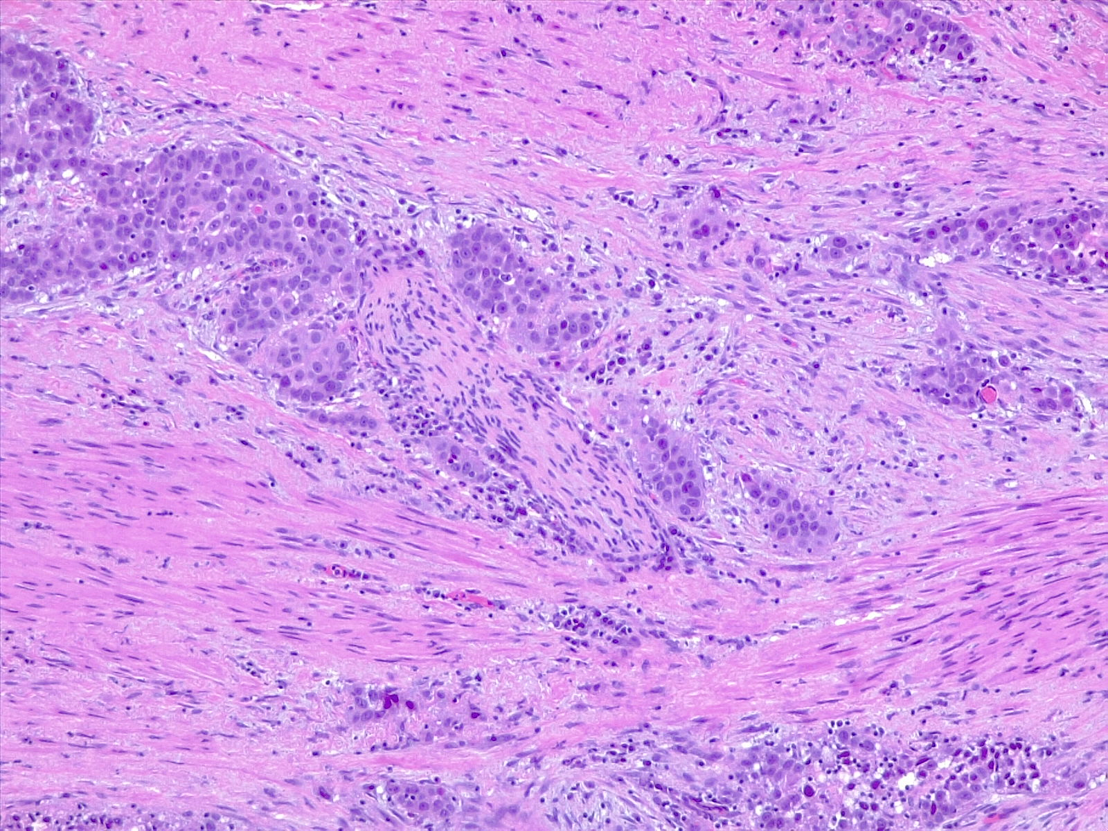 <p>Urothelial Carcinoma, Perineural Invasion. 10&times; H/E.</p>