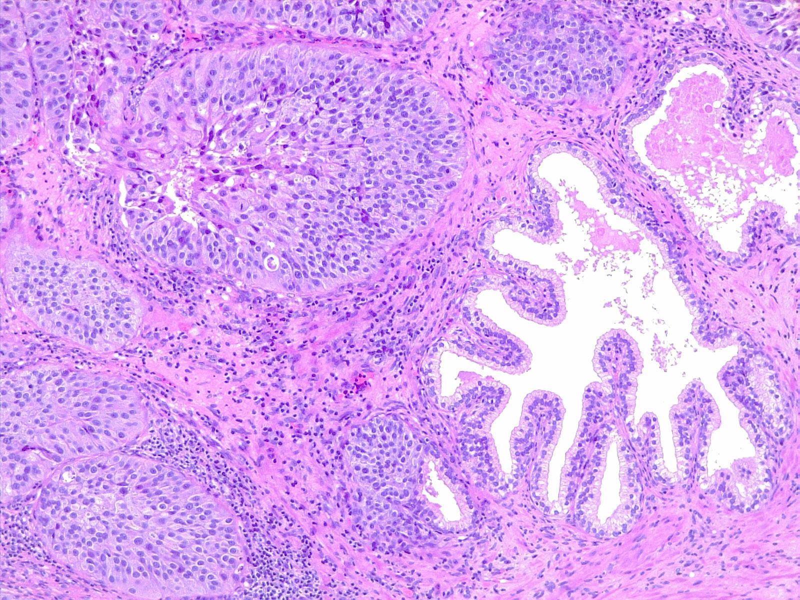 <p>Urothelial Carcinoma, Prostatic Infiltration. 10x H/E.</p>